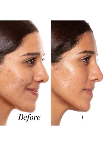 A+ High-Dose Retinoid Serum