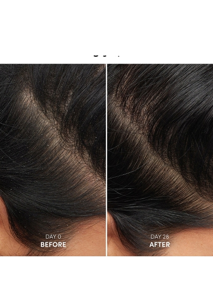 Anti-Dandruff Shampoo